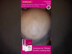 เม็ดเติบโตผมสีแดง