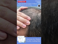 การเจริญเติบโตของเส้นผม